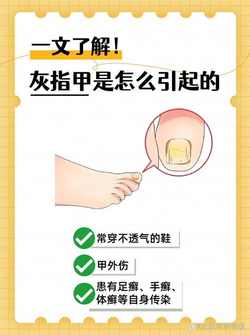 灰指甲要注意什么