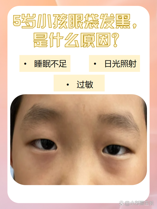 眼袋发黑是什么原因