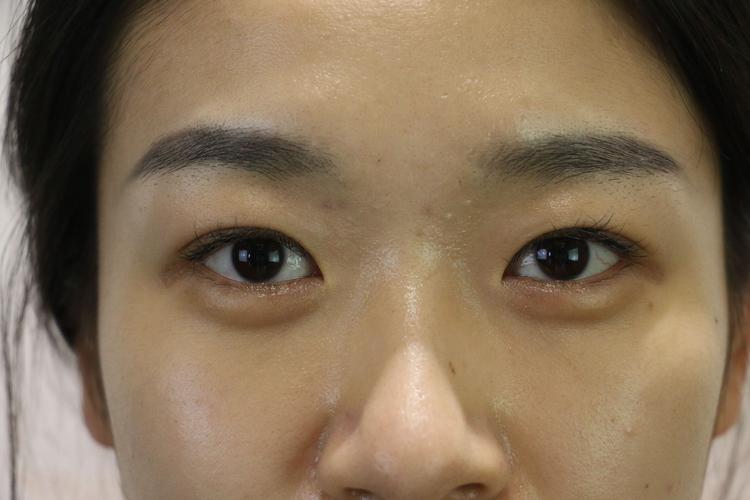 眼综合是什么意思