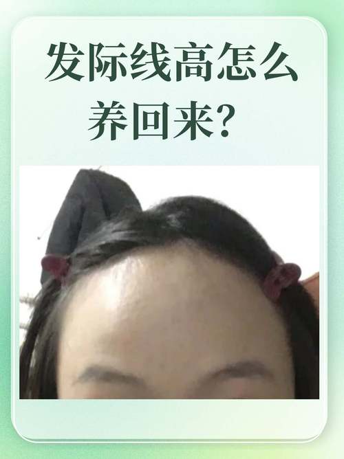 发际线高为什么