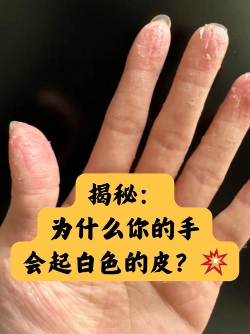 为什么手总是脱皮