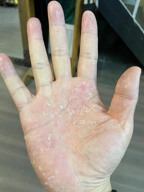 为什么手总是脱皮