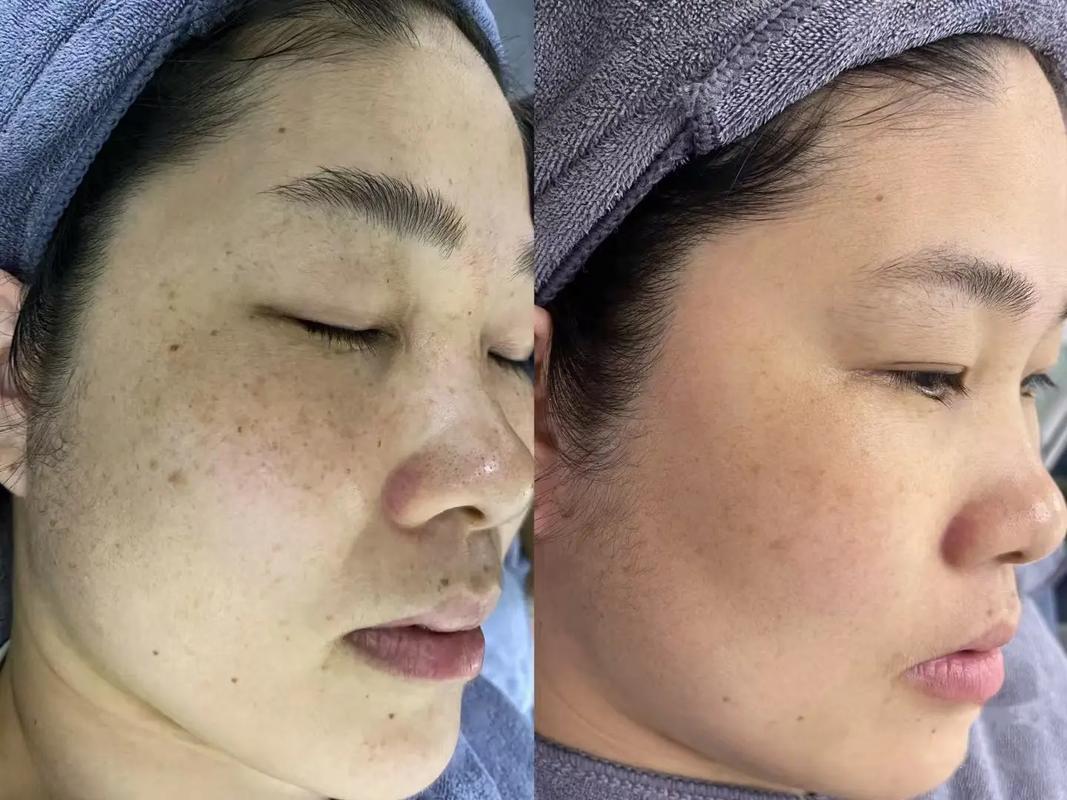 韩国最新祛斑技术