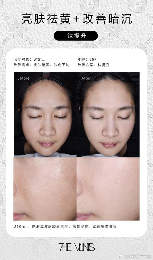 韩国最新祛斑技术