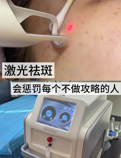 韩国最新祛斑技术