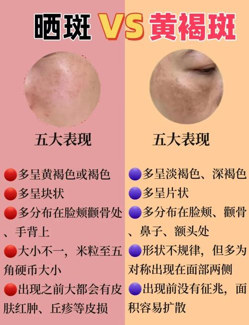 祛斑为什么会反黑