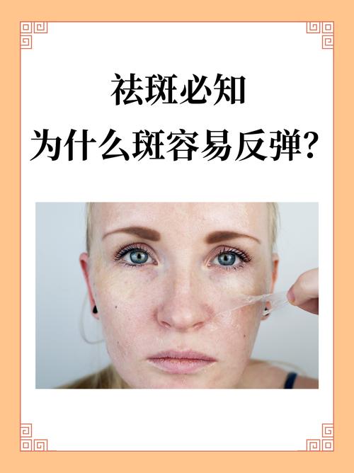 祛斑为什么会反黑