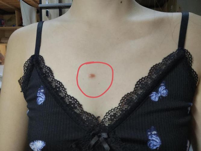 为什么胸前会长痘