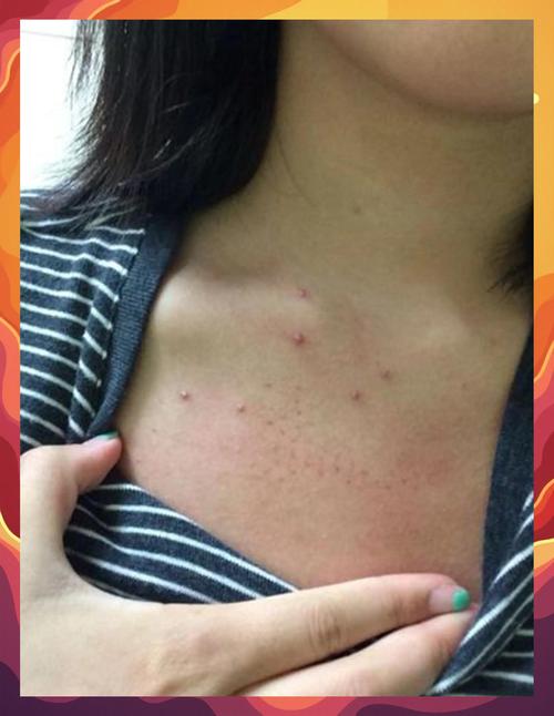 为什么胸前会长痘