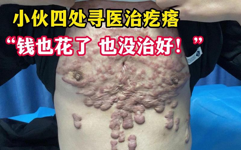 什么是疤痕疙瘩