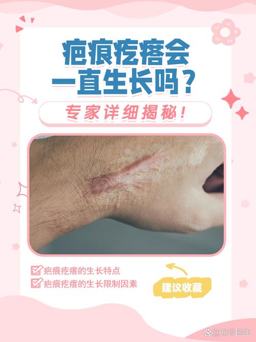 什么是疤痕疙瘩