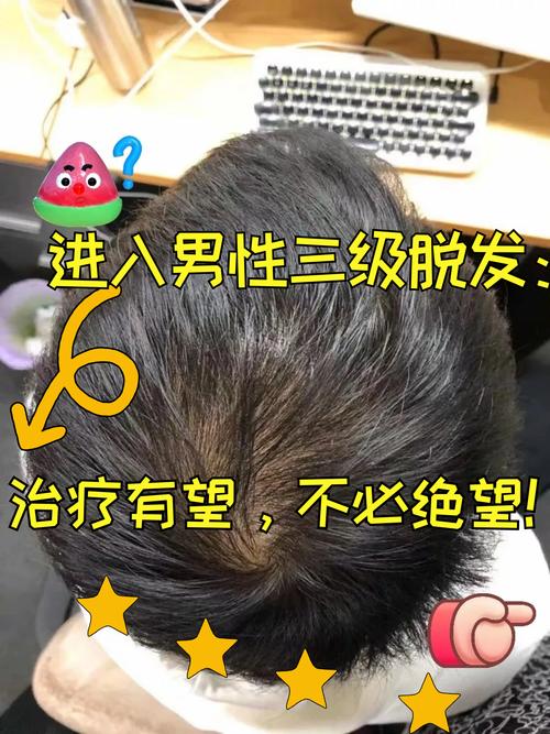 什么程度算脱发