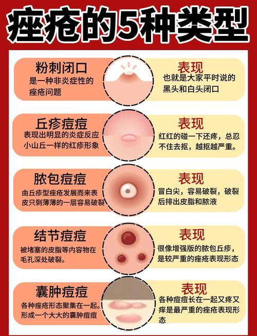 长暗疮是什么原因