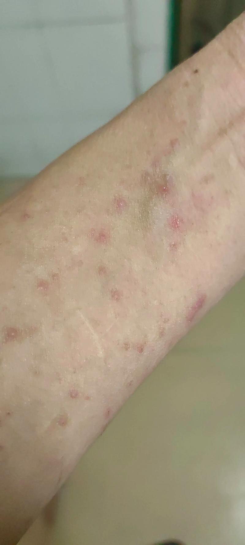 长暗疮是什么原因