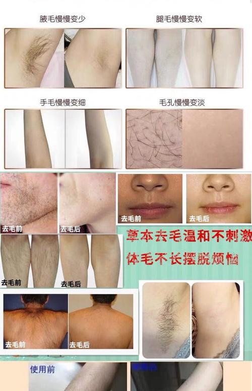 什么东西可以脱毛