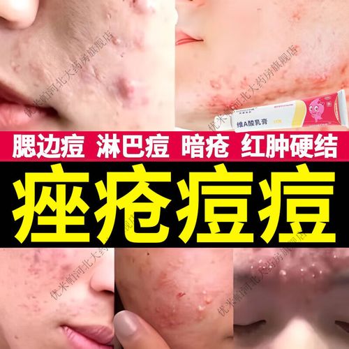 座疮用什么药膏