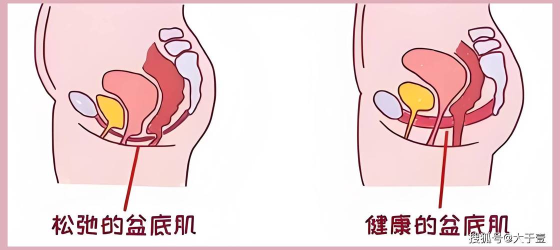 阴道松弛是什么