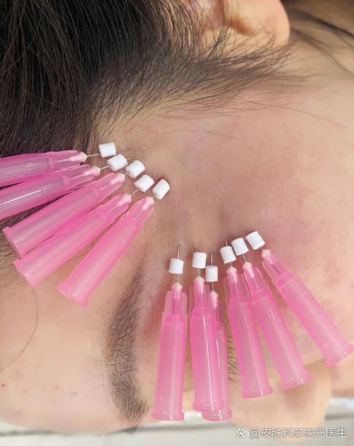 线雕用的是什么线