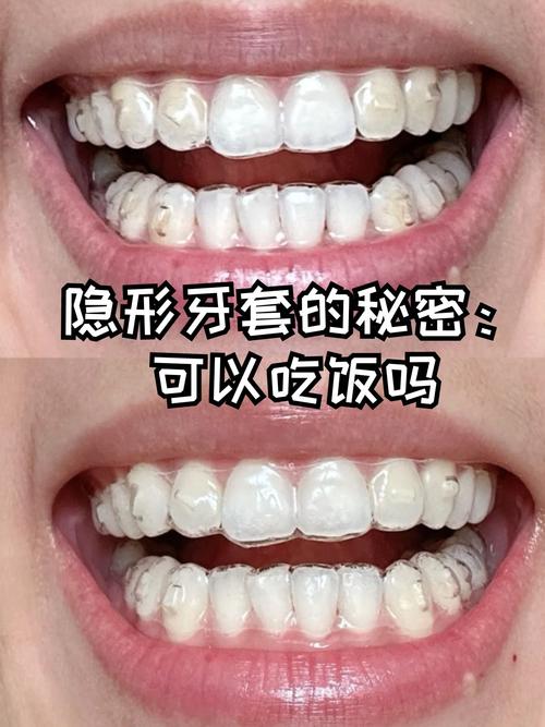 什么是隐形牙套