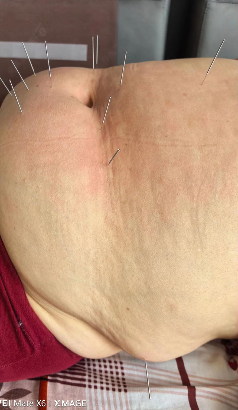 什么体质的人适合针灸减肥