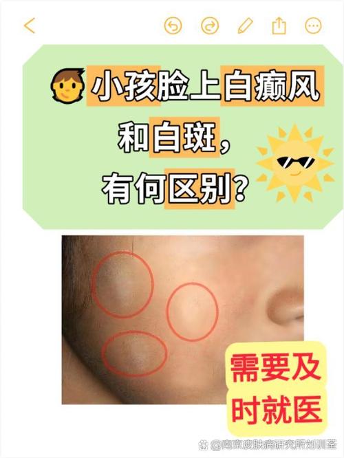 为什么脸上长白斑