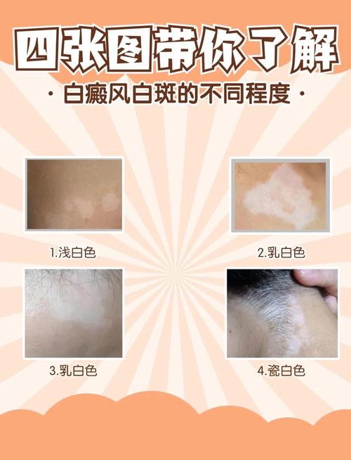 为什么脸上长白斑