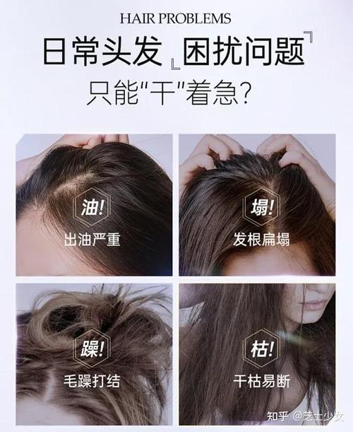 什么治疗脱发最好