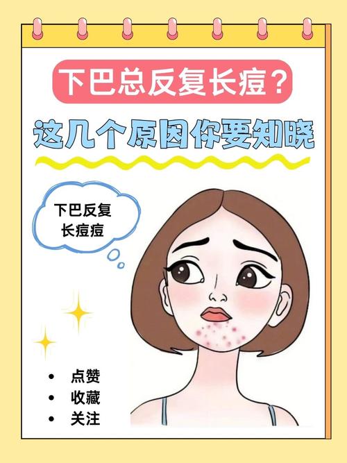 为什么下巴老是长痘