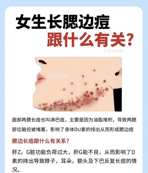 为什么下巴老是长痘