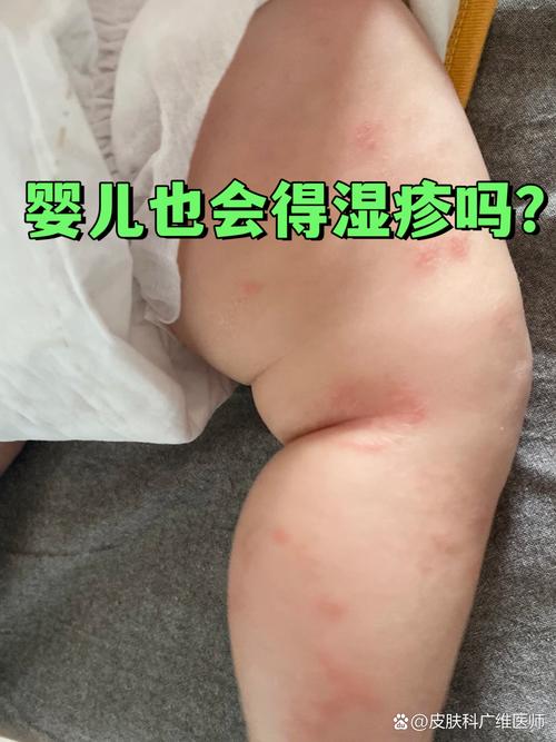 婴儿湿疹挂什么科