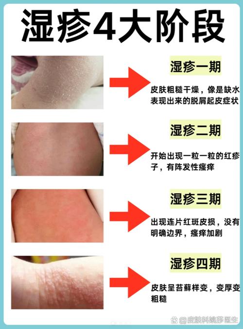 婴儿湿疹挂什么科