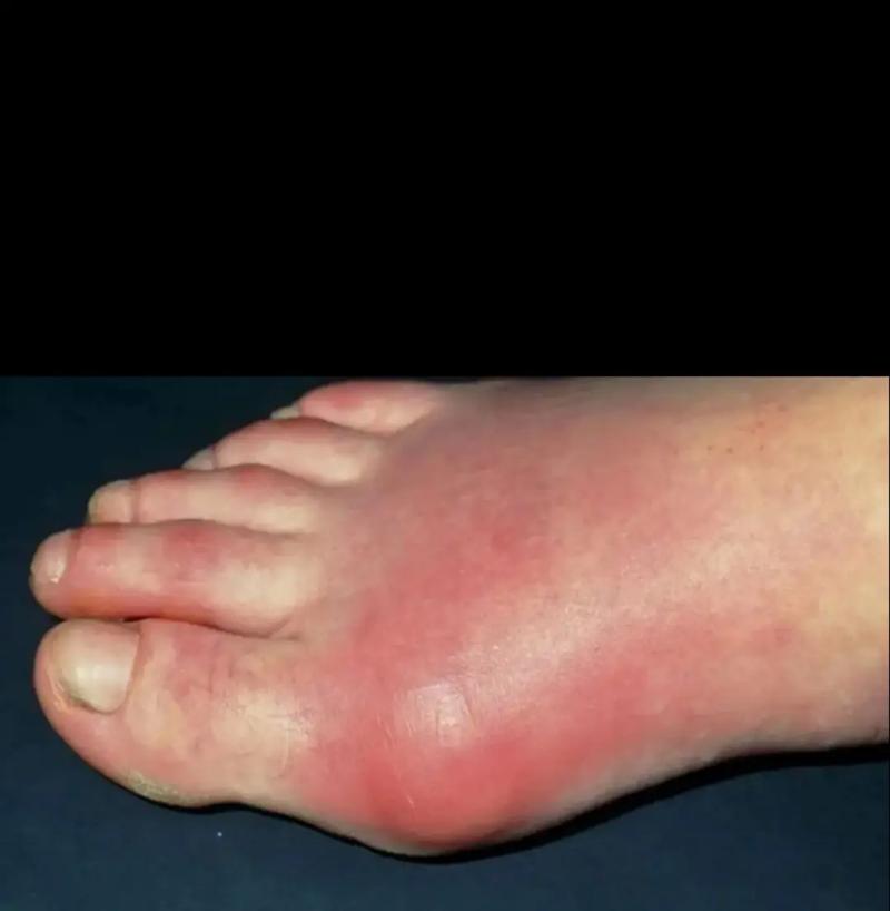 脚手肿是什么原因