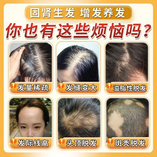 脱发严重吃什么药好