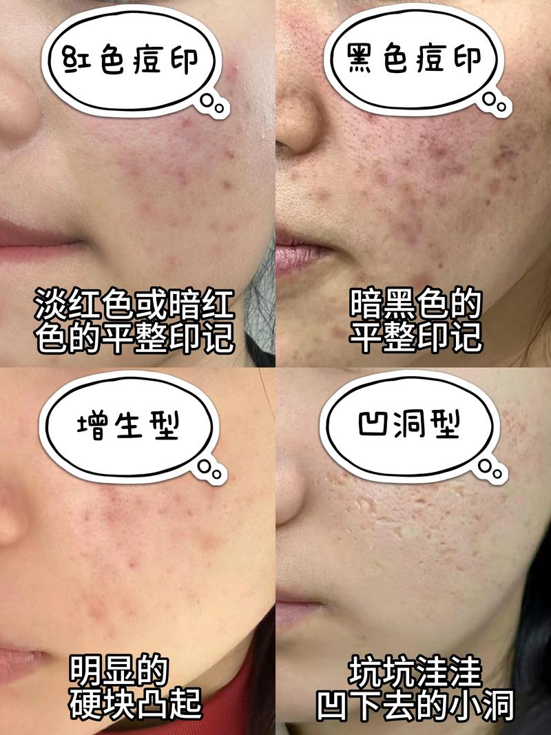 修复痘印用什么好