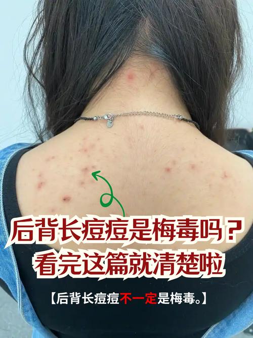 后背起疙瘩什么原因