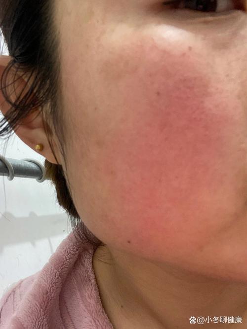 冬天为什么会脸红