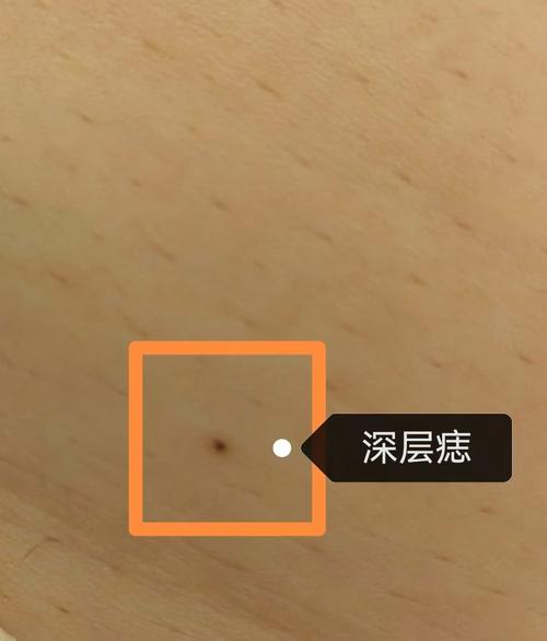 痣点是什么
