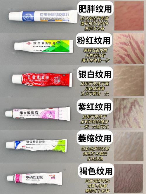肥胖纹用什么药膏