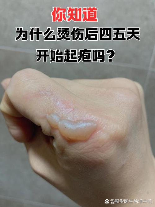 烫伤为什么会起水泡