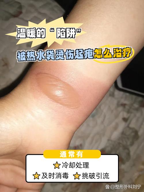 烫伤为什么会起水泡