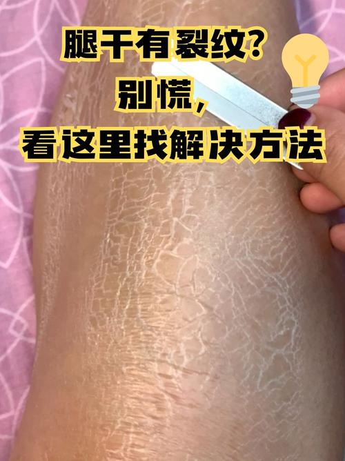 皮肤干裂是什么原因