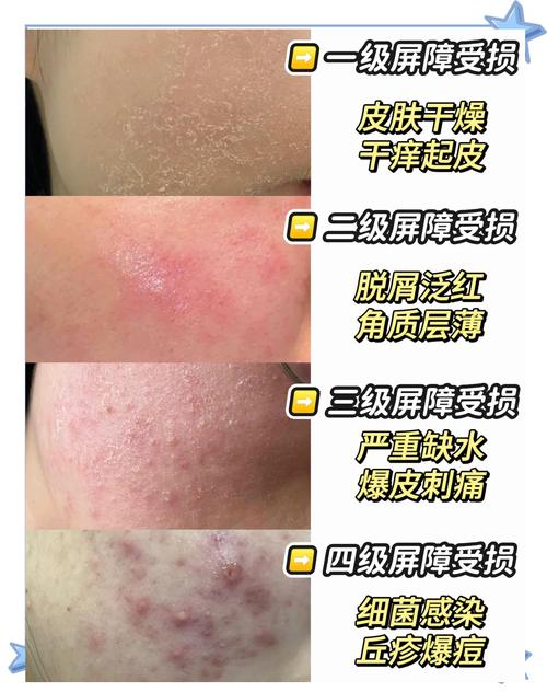 皮肤干裂是什么原因