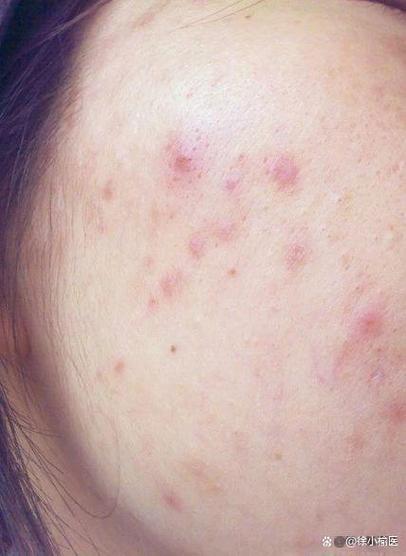 什么皮肤爱长痘