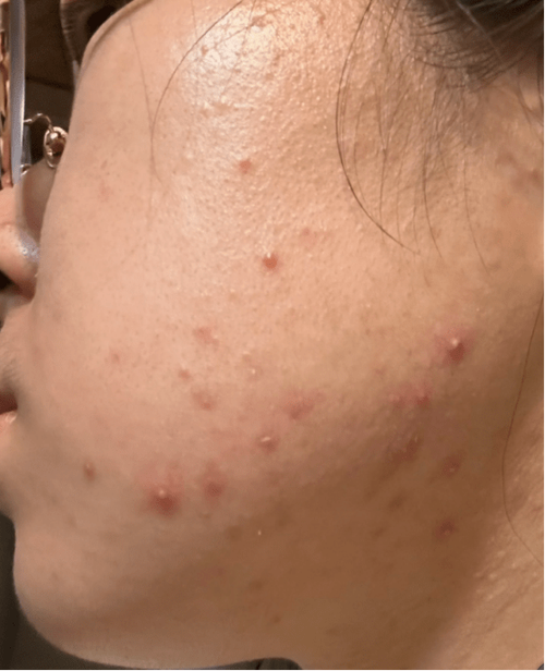 什么皮肤爱长痘