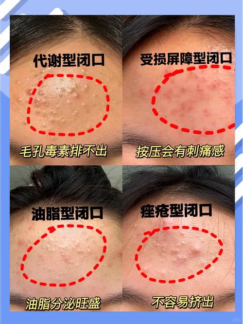 为什么总是长闭口