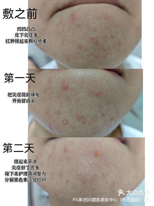 为什么总是长闭口