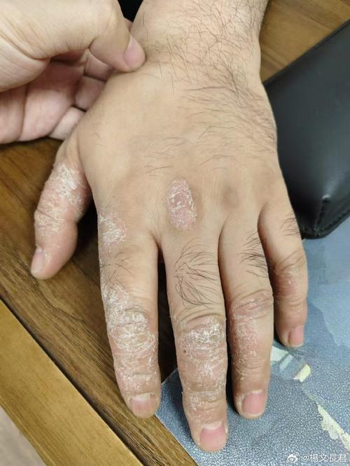 手癣是什么症状