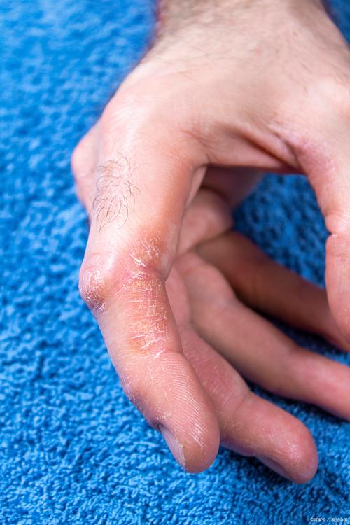 手癣是什么症状