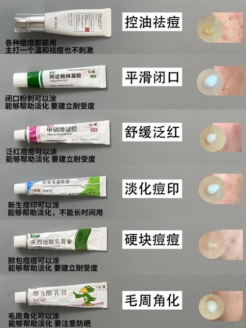 祛痘印用什么效果好