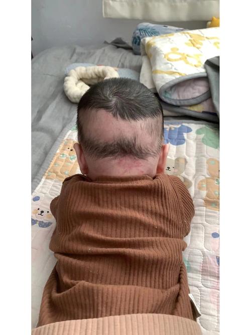 婴儿为什么掉头发
